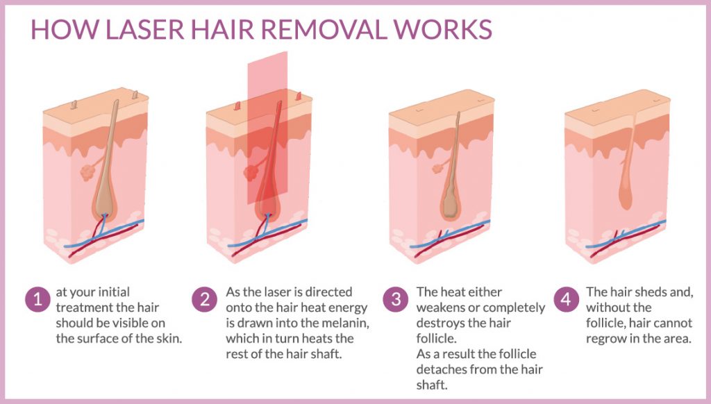 Laser Hair Removal - Mt Tam Laser